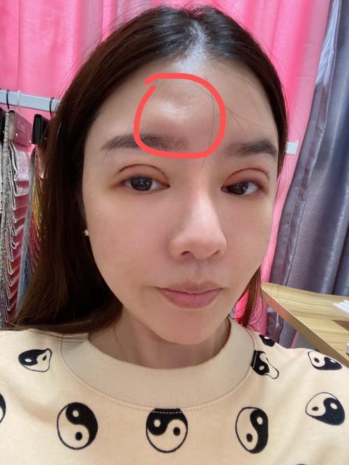南昌:“填补后旺夫”女子做脂肪胶填充手术结果额头上多了个坑 智能家居 南昌:“填补后旺夫”女子做脂肪胶填充手术结果额头上多了个坑 南昌:“填补后旺夫”女子做脂肪胶填充手术结果额头上多了个坑 智能家居