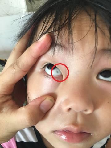 孩子眼白有“黑点”是咋回事?大年夜多是这3种原因作祟年夜夫:别慌 智能科技 孩子眼白有“黑点”是咋回事?大年夜多是这3种原因作祟年夜夫:别慌 孩子眼白有“黑点”是咋回事?大年夜多是这3种原因作祟年夜夫:别慌 智能科技
