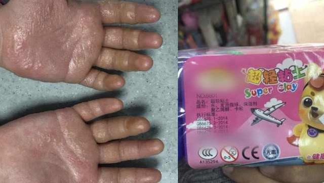 网红玩具“起泡胶”玩得双手起水疱 专家提醒:黏性玩具可能诱发接触性皮炎 智能家居 网红玩具“起泡胶”玩得双手起水疱 专家提醒:黏性玩具可能诱发接触性皮炎 网红玩具“起泡胶”玩得双手起水疱 专家提醒:黏性玩具可能诱发接触性皮炎 智能家居