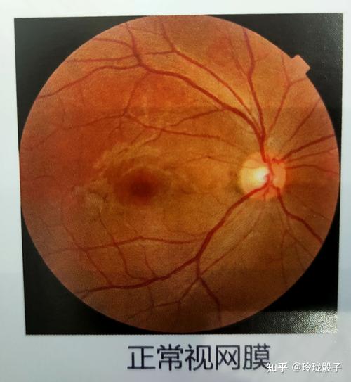 衡阳一小学生眼睛里长出“豹纹”低度数隐藏大年夜损害 智能家居 衡阳一小学生眼睛里长出“豹纹”低度数隐藏大年夜损害 衡阳一小学生眼睛里长出“豹纹”低度数隐藏大年夜损害 智能家居