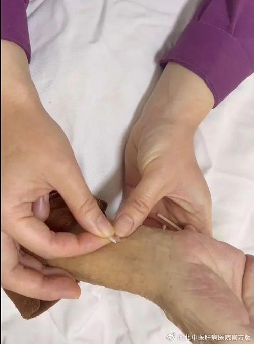 中医治疗新技能揿针治疗 智能科技 中医治疗新技能揿针治疗 中医治疗新技能揿针治疗 智能科技
