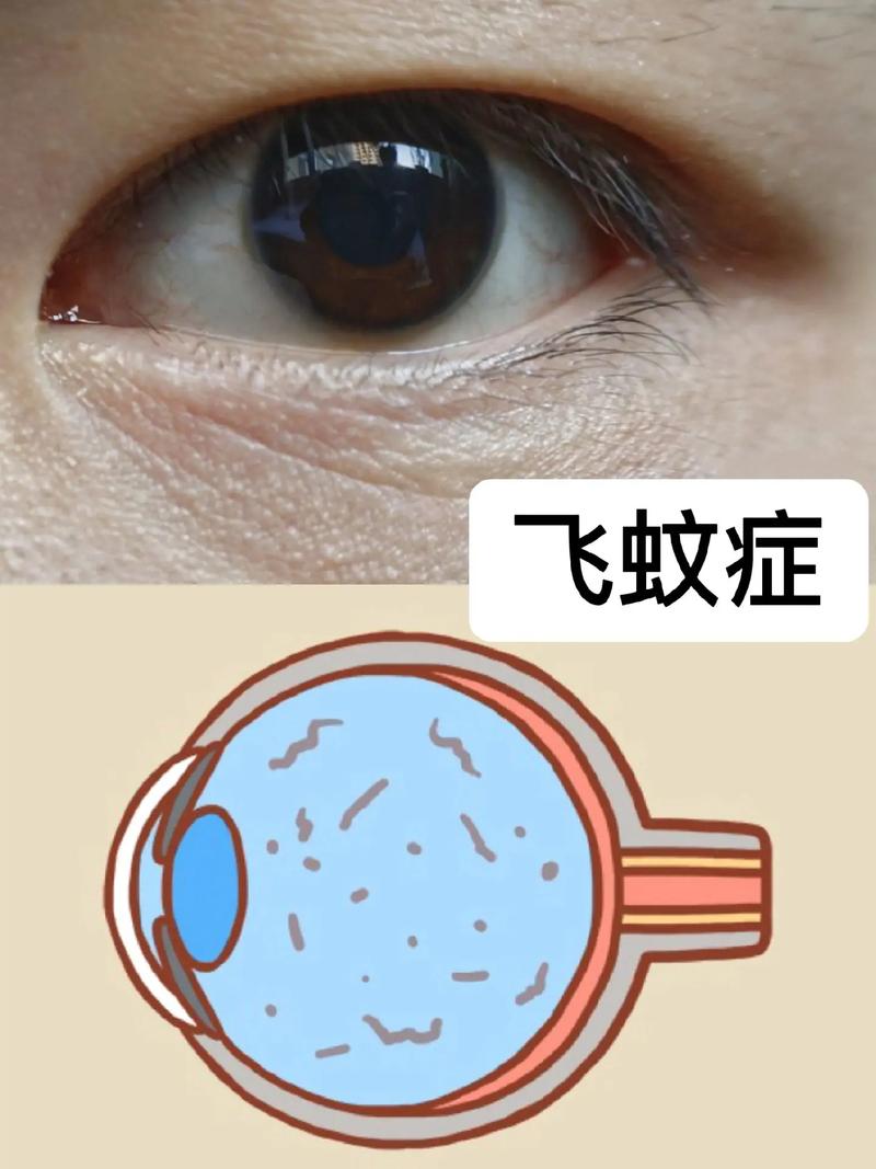 寿命长短眼睛先知?患飞蚊症和白内障的人寿命不长?原形很扎心 人工智能 寿命长短眼睛先知?患飞蚊症和白内障的人寿命不长?原形很扎心 寿命长短眼睛先知?患飞蚊症和白内障的人寿命不长?原形很扎心 人工智能