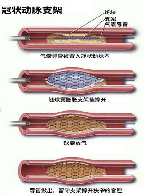 想理解心脏支架的成长进程吗?快来看看吧 智能家居 想理解心脏支架的成长进程吗?快来看看吧 想理解心脏支架的成长进程吗?快来看看吧 智能家居